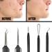 Pete & Pedro Acne & Blackhead Remover Tool Set - 5 Piece Pimple Popper Kit + Mirror | For Men & Women | Removes Whiteheads, Zits, Blackheads, Comedones | Seen on Shark Tank - Buy Online on SooperMarket.com