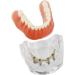 Dental Restore Model with 4 implants implant Demonstration Lower Precision Model Dental Teeth Restoration semi-Covered Prosthesis Decoration - Buy Online on SooperMarket.com