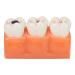 4-fold caries model dental caries model made of synthetic resin safe simulation for professional oral care training students