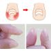 Ingrown Toenail Correction Kit Elastic Toe Nail Straightener Patch with Nail File Glue - Buy Online on SooperMarket.com