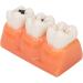 4-Fold Dental Caries Model - Synthetic Resin Oral Care Training Tool for Students | Safe & Realistic Simulation - Buy Online on SooperMarket.com