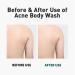 Dashu Daily Acne Relax Body Wash 16.9fl oz - Cooling Acne Treatment - Buy Online on SooperMarket.com