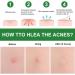 Acne Healing Patch Acne Absorbing Cover Invisible Skin Acne Treatment Stickers for Facial 24Patches acne treatment - Buy Online on SooperMarket.com