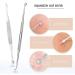 7PC Blackhead Remover Set - Premium Comedone Squeezer Tools for Acne Treatment with Stylish Leather Pouch - Buy Online on SooperMarket.com