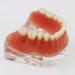 Dental Restore Model with 4 implants implant Demonstration Lower Precision Model Dental Teeth Restoration semi-Covered Prosthesis Decoration - Buy Online on SooperMarket.com