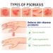 Eczema & Psoriasis Cream - Natural Relief for Dry, Itchy Skin | Scalp Rash Redness Acne - Buy Online on SooperMarket.com