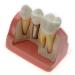 Dental Implant Analysis Demonstration Model - Crown Bridge Teeth Interpretation Model - Buy Online on SooperMarket.com