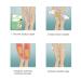 Varicose Veins Patch - Effective Treatment for Spider Veins | 12 Pcs | Fast International Shipping - Buy Online on SooperMarket.com