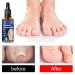 3Pcs German Toenailcare Removal Paronychia Oil for Healthier Toenails - Buy Online on SooperMarket.com