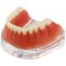 Dental Restore Model with 4 implants implant Demonstration Lower Precision Model Dental Teeth Restoration semi-Covered Prosthesis Decoration - Buy Online on SooperMarket.com