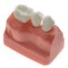 Dental Implant Analysis Demonstration Model - Crown Bridge Teeth Interpretation Model - Buy Online on SooperMarket.com