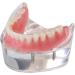 Dental Restore Model with 4 implants implant Demonstration Lower Precision Model Dental Teeth Restoration semi-Covered Prosthesis Decoration - Buy Online on SooperMarket.com