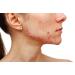 Thursday Plantation Tea Tree Medicated Gel for Acne 25g - Targeted Treatment for Clear Skin - Buy Online on SooperMarket.com