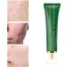 Acne Scar Removal Gel Face Body Marks Skin Repair Cream Acne Treatment Essence 30g acne removal cream - Buy Online on SooperMarket.com