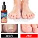 Ingrown Toenail Treatment Correction Drops Nail Growth Treatment Nail Care Ingrowing Toenail Treatment Ingrown Toenail Corrector Treatment for Ingrown Toenail Ingrowing Toenail Improve Toenail Health - Buy Online on SooperMarket.com