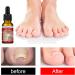 Ingrown Toenail Treatment - 30ml Ingrown Toenail - Cuticle Care Oils for Ingrown Toenails - Trimming Toenail Softening Drops Natural Ingrown Toenail Correction Treatment Fungal Nail Treatment - Buy Online on SooperMarket.com