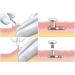 Disposable Sterile Biopsy Punch - 5mm Stainless Steel Dermal Piercing Tool | Safe Skin Punch for Accurate Biopsies | 1pc - Buy Online on SooperMarket.com