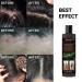 Eczema Psoriasis Anti Dandruff Shampoo for Soothing Dry, Itchy Scalp (200ml) - Buy Online on SooperMarket.com