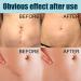Stretch Mark Gel 2Pcs 50ml with Allantoin & Vitamin E - Hydrating Scar Remover for Scars, Burns & Surgery - Buy Online on SooperMarket.com