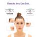 Acotye Pimple Patches - 32 Powerful Large Tea Tree Oil & Salicylic Acid Acne Treatments for Quick Healing of Breakouts on Chin Cheeks & Back - Buy Online on SooperMarket.com