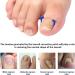 Toenail Patch Ingrown Toenail Toenail Correction Toenail Correction Patch Toenail Correction Patch Ingrown Toenail Nail Care 50 Pieces - Buy Online on SooperMarket.com
