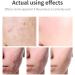 Acne Scar Removal Gel Face Body Marks Skin Repair Cream Acne Treatment Essence 30g acne removal cream - Buy Online on SooperMarket.com