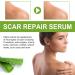 BEALIFE Belly Hip Chest Stretch Mark Removal Ladies Postpartum Body Burn Scars Repair Essence Anti-aging 30ml - Buy Online on SooperMarket.com