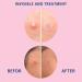 Buy Acne Patches - Invisible Hydrocolloid Spot Stickers for Fast Healing | 108 Translucent Pimple Patches Two Sizes Available - International Shipping - Buy Online on SooperMarket.com