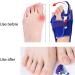 Bunion Toe Splint - Adjustable Strength, Pain-free Movement, Prevents Deviation, Hallux Valgus Support (Left) - Buy Online on SooperMarket.com