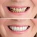 2 PCS Temporary Dentures Teeth for Women and Men - Perfect Fake Teeth to Cover Imperfections in Upper and Lower Jaw - Buy Online on SooperMarket.com