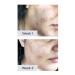 Buy NXN Acne Scar Treatment Gel | Antioxidants & Glycerin for Rapid Blemish Reduction - Effective Face & Body Solution - Buy Online on SooperMarket.com