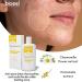 Dermosan CH Anti-Acne Lotion - Chamomile & Hamamelis Natural Clear Skin Formula - Reduce Sebum Acne and Pimple 120ML - Buy Online on SooperMarket.com