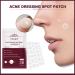Acne Dressing Spot Patch Acne Paste Transparent Pimple Patch Breathable Painless Acne Treatment Gel Patch Skin Care Absorb Pus Rapid Healing Effective Antibacterial Protection 36 Patches - Buy Online on SooperMarket.com