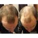 1BAG Hair Building Fibers Instant Hair Loss Treatment Color Powder Conceal Thinning Hair Add Volume For Both Men & Women(Black)  - Buy Online on SooperMarket.com