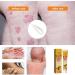 LONGLUAN Youth Bee Venom Anti-Itch Psoriasis Treatment Cream - 2Pcs Set | Soothing & Moisturizing Formula for All Skin Types - Buy Online on SooperMarket.com