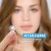 AVJONE Day and Night Hydrocolloid Acne Pimple Patch - 108+36 Vegan-Friendly Spot Stickers for Face and Skin - Buy Online on SooperMarket.com