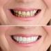 LAMILL DIY Dentures Teeth Veneers for Men and Women - Elastic Tooth Cover - Perfect Smile Solution (2 PCS) - Buy Online on SooperMarket.com