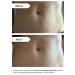 Stretch Mark Eraser | Overnight Treatment for Stretch Marks | 1 Patch | Fast Shipping Worldwide - Buy Online on SooperMarket.com