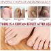 Toenailplus Anti Paronychia Relief Oil - 10ml 2pcs - Nail Helper for Ingrowth Toenail Correction & Paronychia Treatment - Buy Online on SooperMarket.com