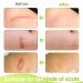 Soft Silicone Scar Tape Roll 1.6x 120 (8 Month Supply) | Reusable & Effective Scar Removal for C-Section, Keloid Surgery, Burn & Acne - Buy Online on SooperMarket.com