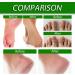 Urea Cream 40 Percent for Feet 40% Urea Cream for Cracked Heels and Dry Skin Aloe Vera Foot Cream with Tea Tree Oil Deep Moisturizing Callus Remover Nourishes Soften for Feet/Knees/Hands/Elbows - Buy Online on SooperMarket.com