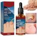 Ingrown Toenail Treatment Toenail Removal Ingrowing Toenail Treatment Nail Growth Treatment Relief Oil Ingrown Toenail Corrector Fungal Toenail Treatment Cuticle Oil Treatment
