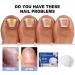 SenhE Fungus Laser Therapy Device Antibacterial Laser Equipment Light Therapy Device Fungal Nail Revolutionary High-Efficiency Light Therapy Device for Toenail Diseases  - Buy Online on SooperMarket.com