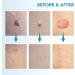 OakRidge Products Skin Tag Remover Painless Pen Removal Kit Tools with 40 Micro and Regular Bands Easy Device to Remove(1mm-8mm) Tags (2in1 Kit) (2-8mm) Blue Number Of Items: 1 1.0 count - Buy Online on SooperMarket.com