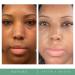Replenix Glycolic Acid Resurfacing Cleanser - Medical Grade Exfoliating Face Wash | Brightens Skin, Minimizes Pores & Evens Skin Tone | 6.7 oz - Buy Online on SooperMarket.com