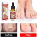 Ingrown Toenail Treatment Nail Growth Ingrowing Toenail Treatment Nail Helper Fungal Nail Treatment Correction Oil Drops Ingrown Toenail Corrector Toe Nail Fungus Treatment Cuticle Oil - Buy Online on SooperMarket.com