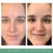 Benzoyl Peroxide Acne Gel Spot Treatment - Maximum Strength 10% Medical Grade Pimple Cream - Buy Online on SooperMarket.com