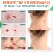 Skin-Tag-Remover Kit Remover for Verruca-Treatment - 30ml - Buy Online on SooperMarket.com