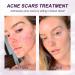 Marianp Hyaluronic Acid Serum & Azelaic Acid 10% for Acne Pigmentation & Rosacea - Vitamin B3 & B5 | Best Skincare Treatment - Buy Online on SooperMarket.com