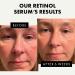 Retinol Serum for Face - 2.5% Pure Anti-Wrinkle Serum with Hyaluronic Acid & Vitamin B3 | Resurfacing Anti-Aging Treatment for Men & Women - Facial Acne Solution - Buy Online on SooperMarket.com